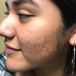 March 24 image of woman with acne scars before NME treatment