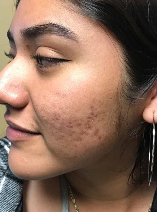 18 yo acne scars before