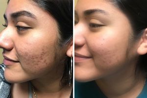 acne-scars-before-and-after