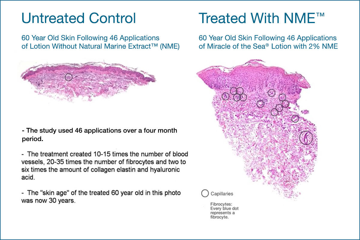 Natural Marine Extract Biopsy Proof Thin Skin Gets Thicker